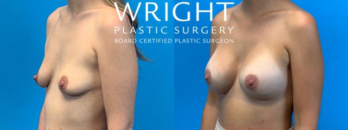 Before & After Breast Augmentation Case 400 Left Oblique View in Little Rock, Arkansas
