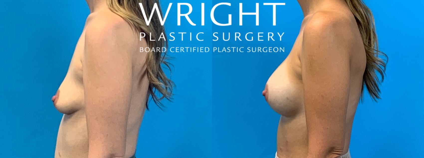Before & After Breast Augmentation Case 400 Left Side View in Little Rock, Arkansas