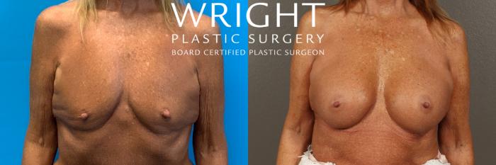 Before & After Breast Augmentation Case 410 Front View in Little Rock, Arkansas