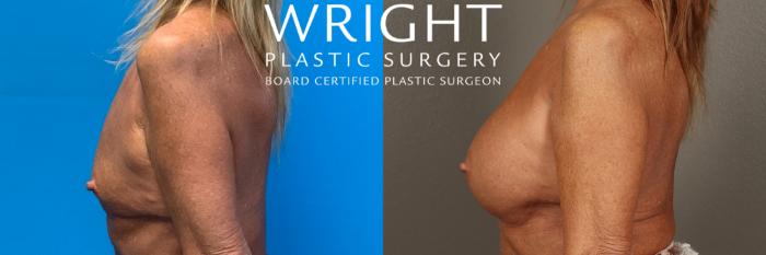 Before & After Breast Augmentation Case 410 Left Side View in Little Rock, Arkansas