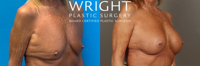 Before & After Breast Augmentation Case 410 Right Oblique View in Little Rock, Arkansas