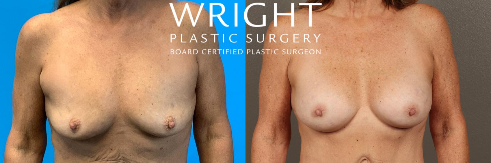 Before & After Breast Augmentation Case 411 Front View in Little Rock, Arkansas