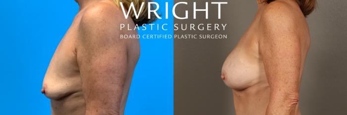 Before & After Breast Augmentation Case 411 Left Side View in Little Rock, Arkansas
