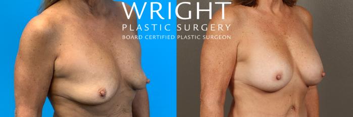 Before & After Breast Augmentation Case 411 Right Oblique View in Little Rock, Arkansas