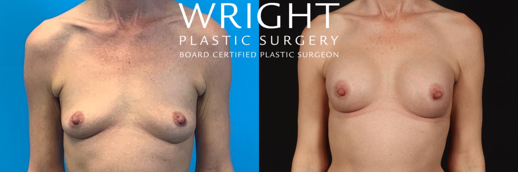 Before & After Breast Augmentation Case 413 Front View in Little Rock, Arkansas