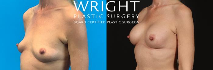 Before & After Breast Augmentation Case 413 Left Oblique View in Little Rock, Arkansas