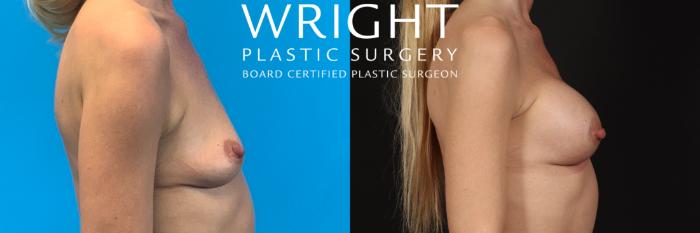 Before & After Breast Augmentation Case 413 Right Side View in Little Rock, Arkansas