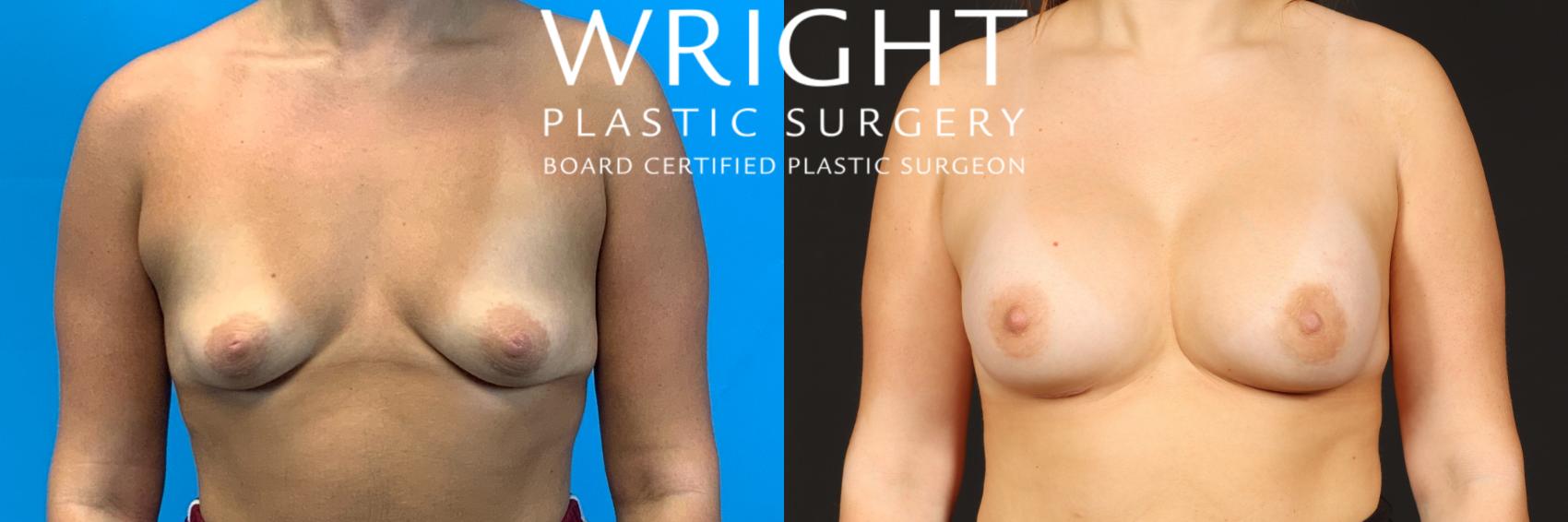 Before & After Breast Augmentation Case 441 Front View in Little Rock, Arkansas