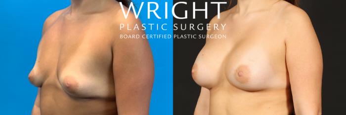Before & After Breast Augmentation Case 441 Left Oblique View in Little Rock, Arkansas