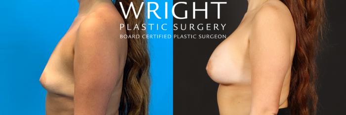 Before & After Breast Augmentation Case 441 Left Side View in Little Rock, Arkansas