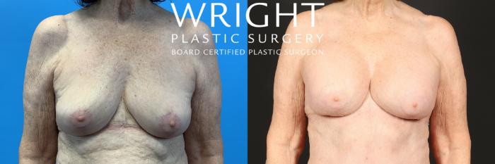 Before & After Breast Augmentation Case 444 Front View in Little Rock, Arkansas