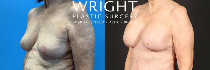 Before & After Breast Augmentation Case 444 Left Oblique View in Little Rock, Arkansas