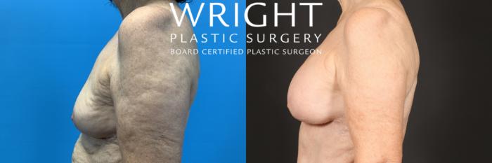 Before & After Breast Augmentation Case 444 Left Side View in Little Rock, Arkansas