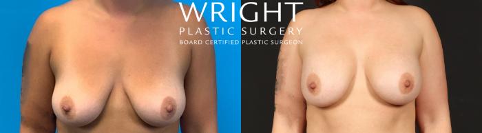 Before & After Breast Augmentation Case 452 Front View in Little Rock, Arkansas