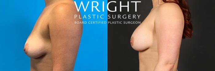 Before & After Breast Augmentation Case 452 Left Side View in Little Rock, Arkansas