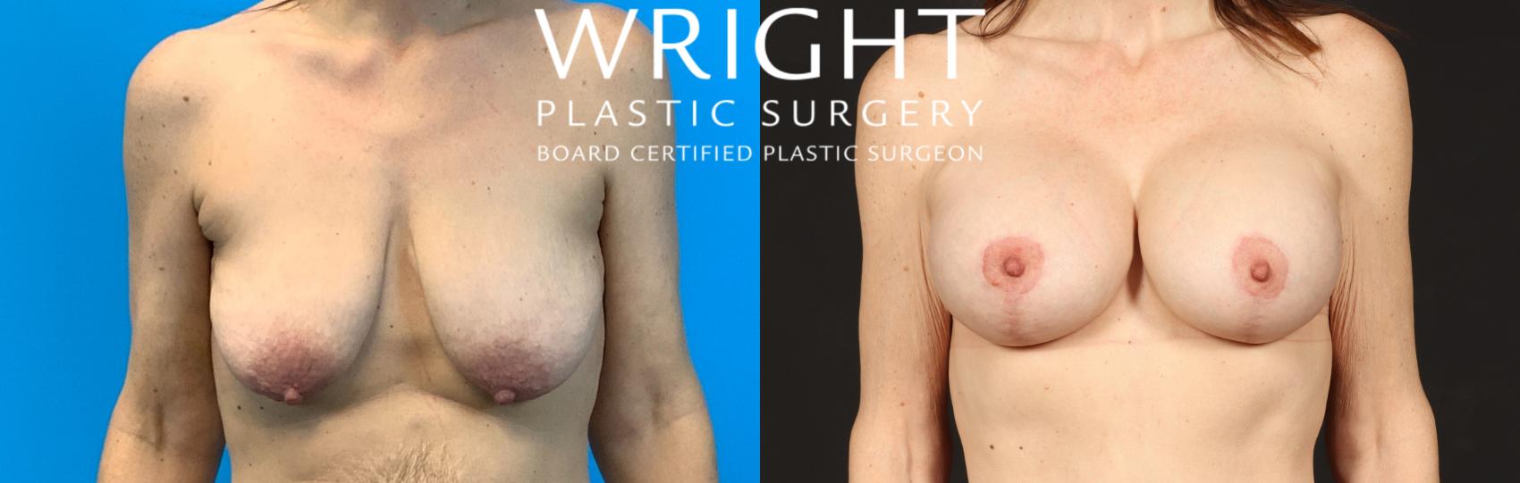 Before & After Breast Lift Case 465 Front View in Little Rock, Arkansas