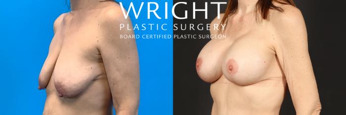 Before & After Breast Augmentation Case 465 Left Oblique View in Little Rock, Arkansas