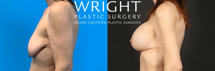 Before & After Breast Lift Case 465 Left Side View in Little Rock, Arkansas