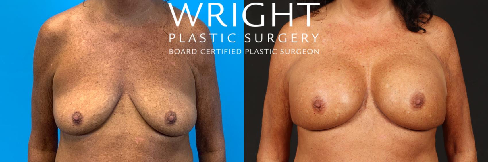 Before & After Breast Augmentation Case 468 Front View in Little Rock, Arkansas