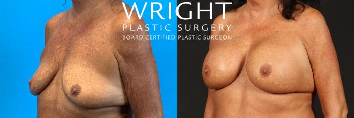 Before & After Breast Augmentation Case 468 Left Oblique View in Little Rock, Arkansas