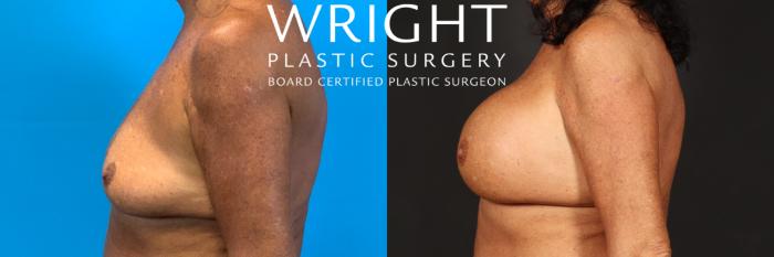 Before & After Breast Augmentation Case 468 Left Side View in Little Rock, Arkansas