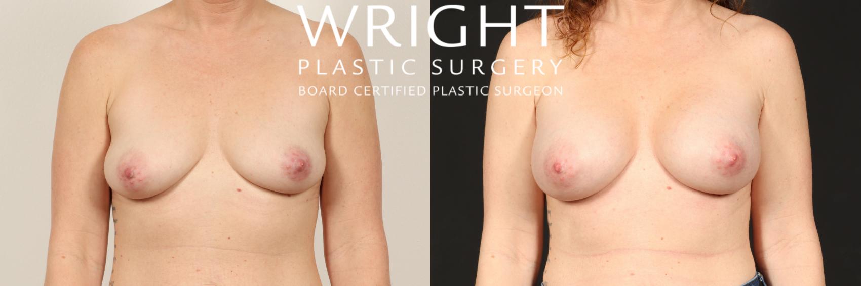 Before & After Breast Augmentation Case 470 Front View in Little Rock, Arkansas