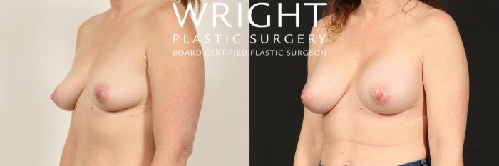 Before & After Breast Augmentation Case 470 Left Oblique View in Little Rock, Arkansas
