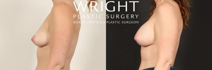 Before & After Breast Augmentation Case 470 Left Side View in Little Rock, Arkansas