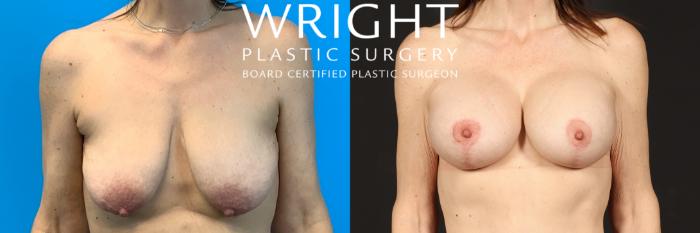 Before & After Breast Augmentation Case 471 Front View in Little Rock, Arkansas