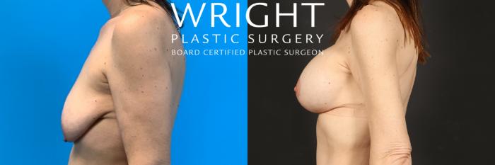 Before & After Breast Augmentation Case 471 Left Side View in Little Rock, Arkansas