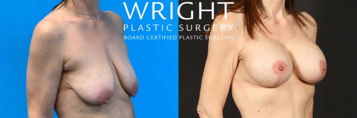 Before & After Breast Augmentation Case 471 Right Oblique View in Little Rock, Arkansas
