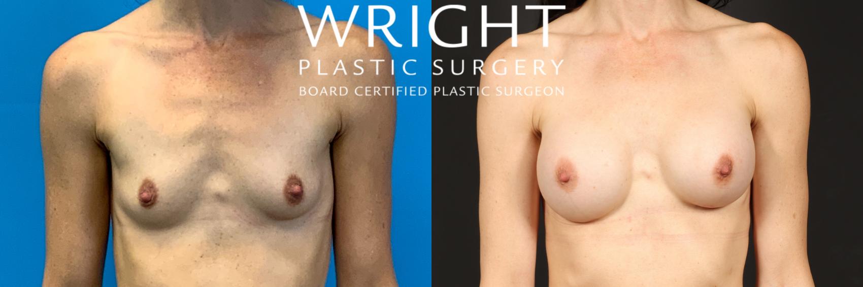 Before & After Breast Augmentation Case 482 Front View in Little Rock, Arkansas