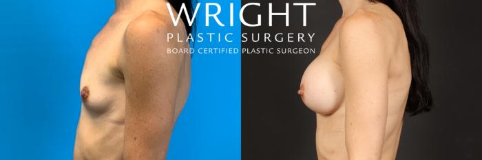 Before & After Breast Augmentation Case 482 Left Side View in Little Rock, Arkansas