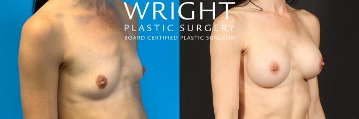 Before & After Breast Augmentation Case 482 Right Oblique View in Little Rock, Arkansas