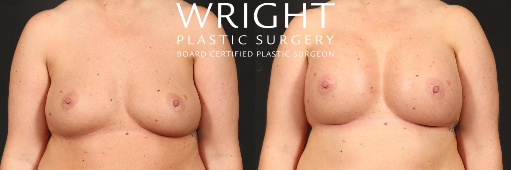 Before & After Breast Augmentation Case 493 Front View in Little Rock, Arkansas