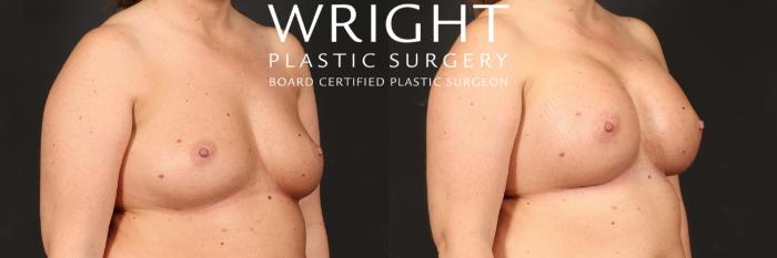 Before & After Breast Augmentation Case 493 Right Oblique View in Little Rock, Arkansas