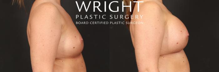 Before & After Breast Augmentation Case 493 Right Side View in Little Rock, Arkansas