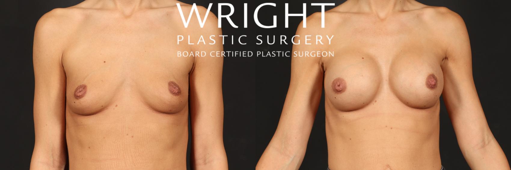 Before & After Breast Augmentation Case 497 Front View in Little Rock, Arkansas