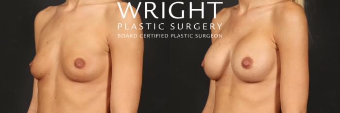 Before & After Breast Augmentation Case 497 Left Oblique View in Little Rock, Arkansas