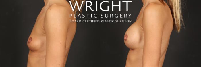 Before & After Breast Augmentation Case 497 Left Side View in Little Rock, Arkansas