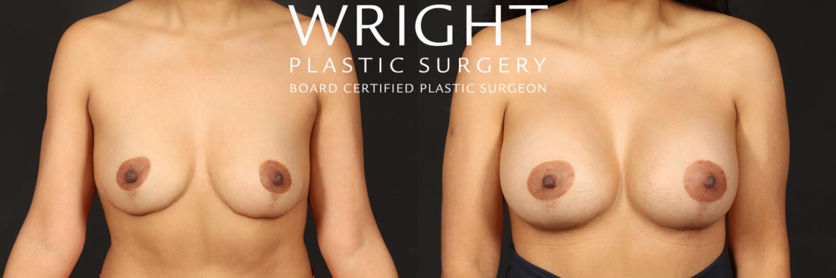 Before & After Breast Augmentation Case 499 Front View in Little Rock, Arkansas