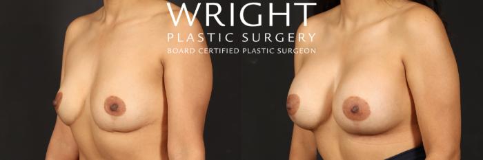 Before & After Breast Augmentation Case 499 Left Oblique View in Little Rock, Arkansas