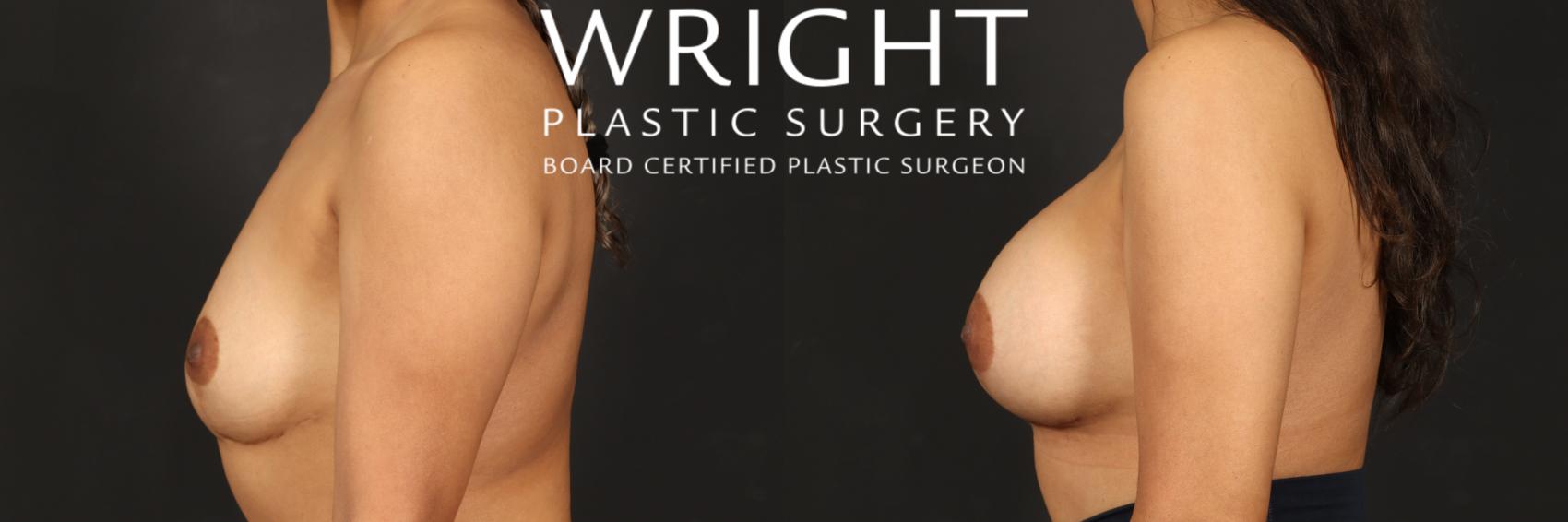Before & After Breast Augmentation Case 499 Left Side View in Little Rock, Arkansas