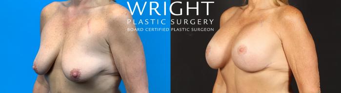 Before & After Breast Augmentation Case 503 Left Oblique View in Little Rock, Arkansas