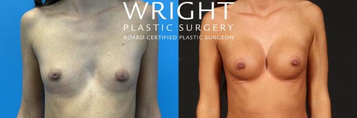 Before & After Breast Augmentation Case 505 Front View in Little Rock, Arkansas