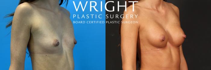 Before & After Breast Augmentation Case 505 Right Oblique View in Little Rock, Arkansas