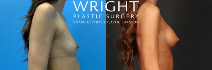 Before & After Breast Augmentation Case 505 Right Side View in Little Rock, Arkansas