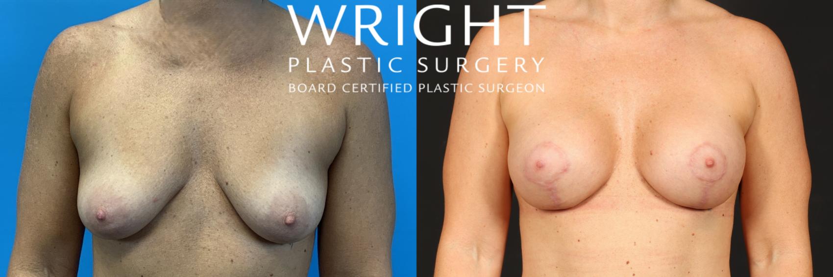 Before & After Breast Augmentation Case 508 Front View in Little Rock, Arkansas