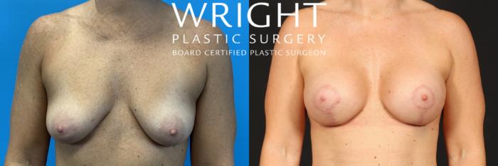 Before & After Breast Augmentation Case 508 Front View in Little Rock, Arkansas