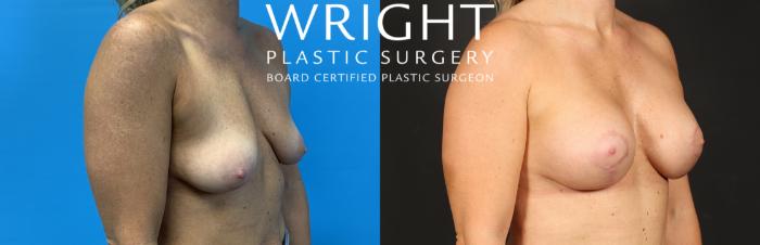 Before & After Breast Augmentation Case 508 Right Oblique View in Little Rock, Arkansas